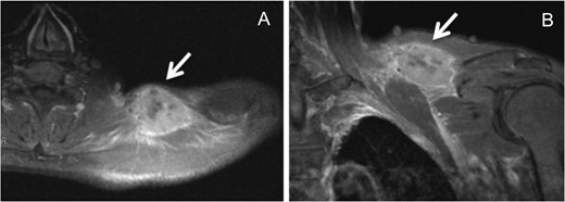 A hyperintensity mass between the trapezius and supraspinatus on T1-weighted magnetic resonance imaging (A, axial view; B, coronal view).