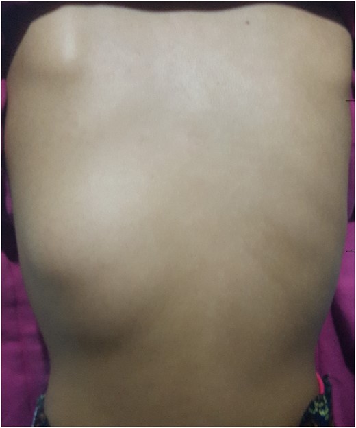 Physical examination: a swelling of the left posterior chest wall of ~6 × 4 cm2.