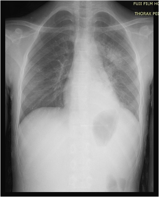 A normal chest radiograph.