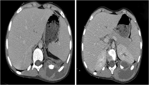 Soft tissue and bone windows of a chest CT scan show a 6-3-5 cm pus collection of posterior chest wall. The mass appeared to traverse kidney capsule and the thoracic cage to be continuous with a pleural-based mass adjacent to it.