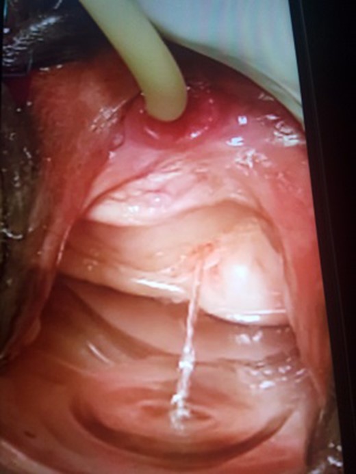 Direct dye test: 300 ml methylene blue instilled into the bladder through Foley catheter shows no dye leak, but a clear stream of urine spilling from the left ureter.