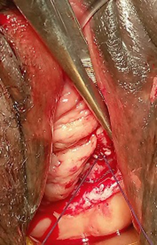 Bladder closed over left reimplanted ureter, with ureteral catheter exiting the external urethral meatus.