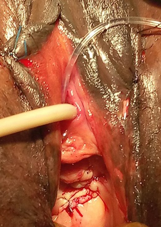 Anterior vaginal wall closure with ureteral and urethral catheters exiting from the external urethral meatus.