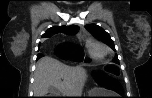 Coronal view of herniated colon on computed tomography scan obtained at the referring facility prior to transfer.