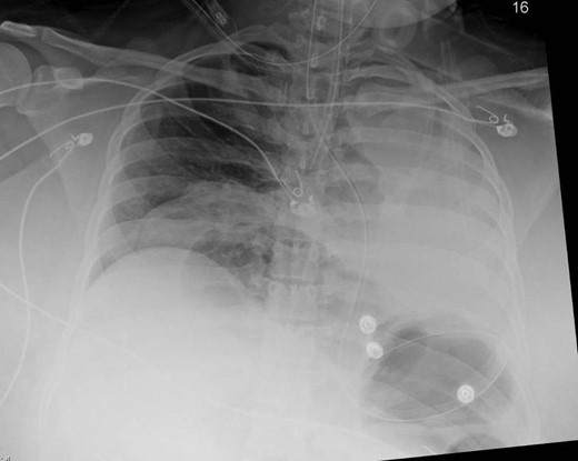 Anterior–posterior chest x-ray obtained after intubation demonstrating bowel loops and a coiled nasogastric tube within the stomach, above the diaphragm and a coiled nasogastric tube above the diaphragm.