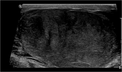 Right testicular Doppler US showing hypo-echoic areas with heterogeneous echo-texture.