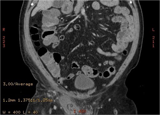 A coronal cut of and enhanced abdominal CT scan showing enlarged right spermatic cord and areas of decreased right testicular enhancement suggesting torsion.