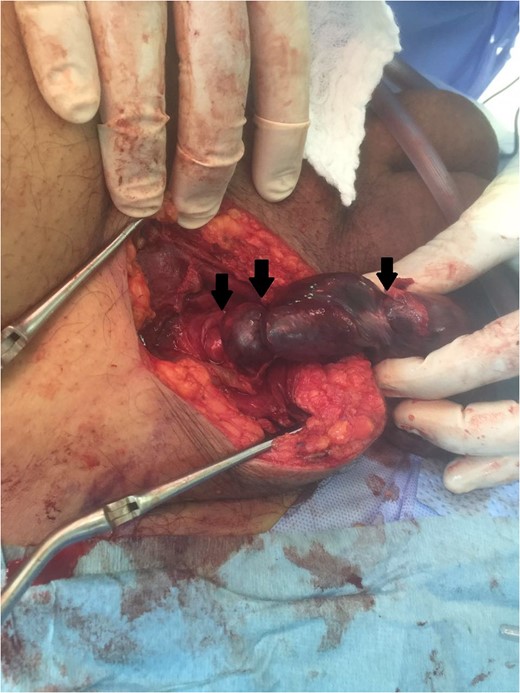 An intra-operative photo showing torsion areas (black arrows).