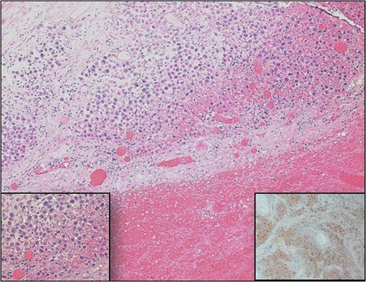 Testicular histopathology. Sections from testis show extensive hemorrhage with an area showing sheets of large round cells with clear cytoplasm. (Inset left) High power of cells show prominent nucleoli and vacuolated clear cytoplasm. (Inset right) Immunohistochemical staining of placental alkaline phosphatase (PLAP) confirms the diagnosis of classical seminoma.