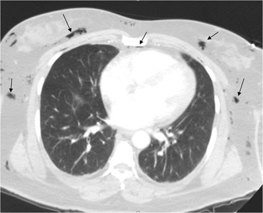 Pneumomediastinum and subcutaneous emphysema as indicated by the arrows.