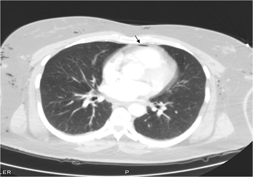 Pneumomediastinum shown by a small arrow.