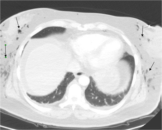 Again depicting subcutaneous emphysema.
