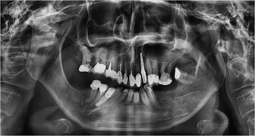 Panoramic radiograph at the age of 63 illustrating a mandibular asymmetry with extensive remodeling of the right condyle–fossa complex. The mandibular condyle and adjacent temporal bone structures can no longer be discerned. Note the superimposition of a silicone soft tissue implant as a noninvasive approach to compensate for the mandibular asymmetry.