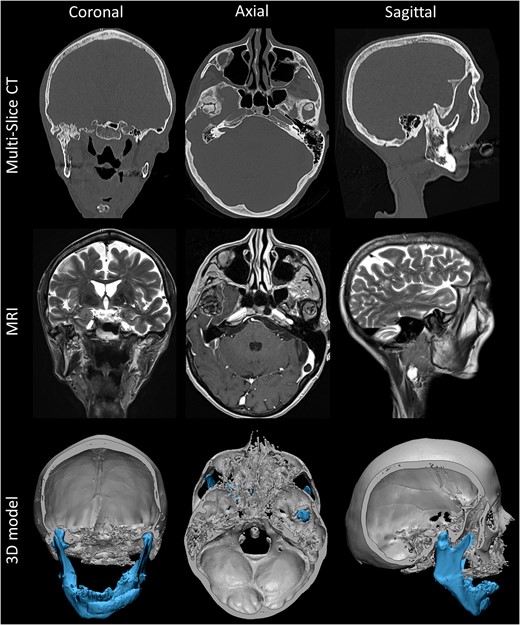 CT and MR skull imaging, using axial gadolinium enhanced T1-weighted and coronal and sagittal T2-weighted MR images, and related 3D model with mandibular segmentation and digital removal of the calvarium. Note the extent of remodeling and asymmetrical development throughout the subsequent years with even upward relocation of the right inferior temporal gyrus.
