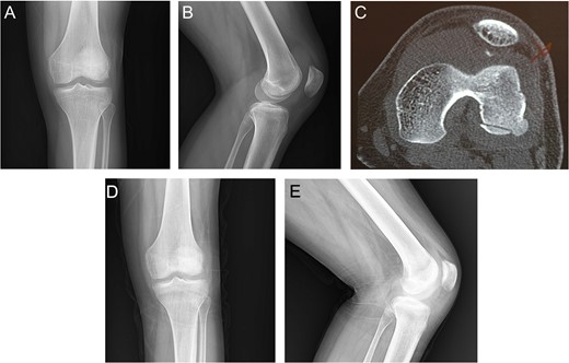 Case 1. A and B Radiography showing lateral femoral condyle OCF. C, CT scan showing OCF and patellar avulsion fragment.D and E, 3 months postoperative radiography showing complete union.