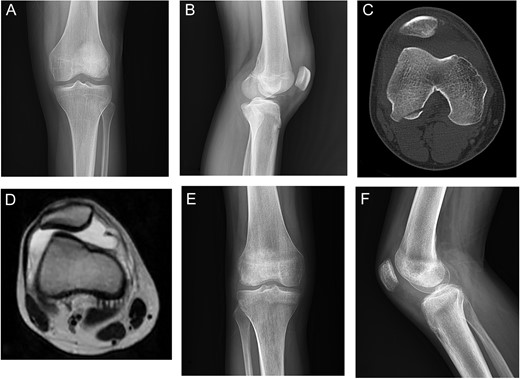 Case 2. A and B Radiography showing lateral femoral condyle OCF and marked effusion. C, CT scan showing lateral patellar subluxation with medial patellar avulsion fracture and lateral femoral condyle OCF. D, MRI showing lateral patellar subluxation and marked joint effusion. E and F, 3 months postoperative radiography showing complete union.