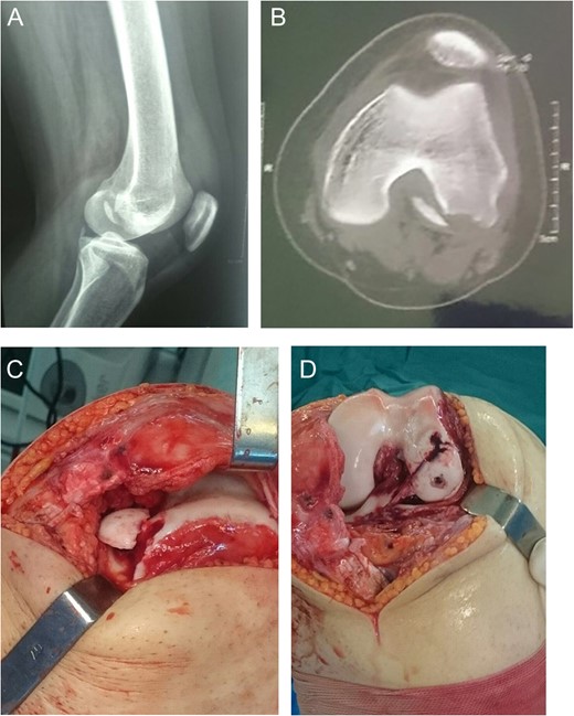 Case 3. A, Radiography showing lateral femoral condyle OCF. B, CT scan showing OCF and lateral patellar subluxation. C and D, Intraoperative photography showing weight-bearing position of OCF and fixation with bioscrews.