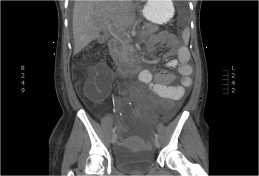 CT of dilated portal vein and thrombosis (frontal view).
