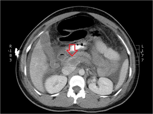 CT of dilated portal vein and extension of thrombosis (axial view).