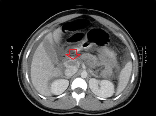 CT of dilated portal vein and thrombosis (axial view).
