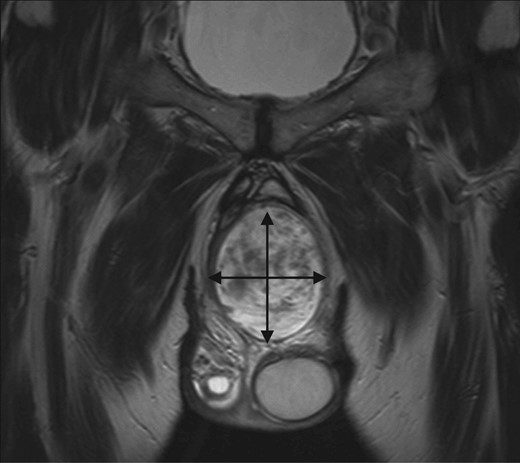 MRI abdomen and pelvis T2 weighted sequence coronal view demonstrating well-defined heterogeneous mass within the perineum.