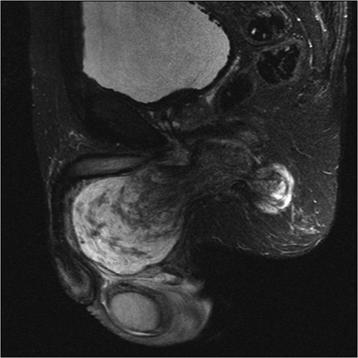 MRI abdomen and pelvis T2 weighted sequence sagittal view showing a predominantly cystic mass with scattered solid components within perineum.