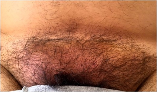 As presented in the emergency room by a 38-year old patient with a tender suprapubic swelling and local signs of inflammation (rubor, calor, dolor, tumor).