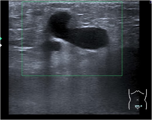 Tubular, hypoechoic, non-compressible, inguinal mass with no flow evident in color Doppler imaging.