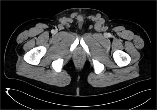 A CT-abdomen revealed suprapubic crossover collaterals due to ilio-femoral vein occlusion secondary to DVT.