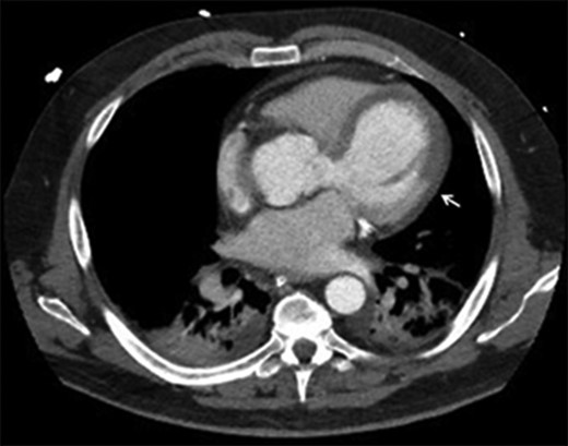 CT aorta: arrow points at the differential myocardial enhancement corresponding to large area of infarct.