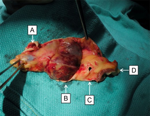 (A) Left main coronary artery with a tear and coronary stent in place. (B) Hematoma involving the aortic root at the non-coronary sinus. (C) Right coronary artery ostium. (D) Septal muscle.