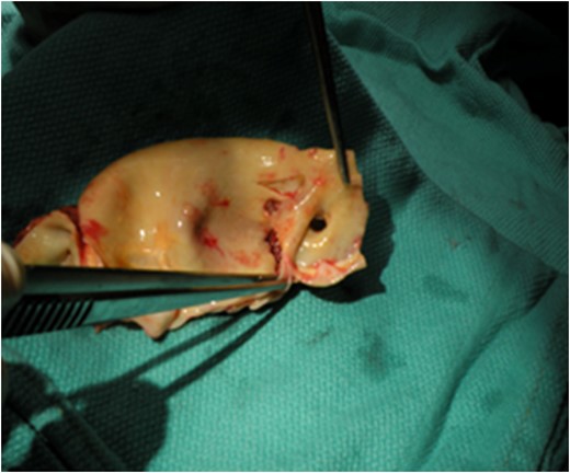 Intimal flap involving left coronary sinus and left main coronary ostium.