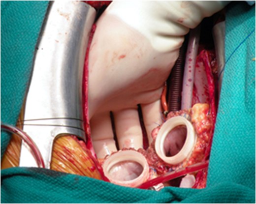 The quick-connect cusps were sutured to the annulus of both mitral and tricuspid valve.