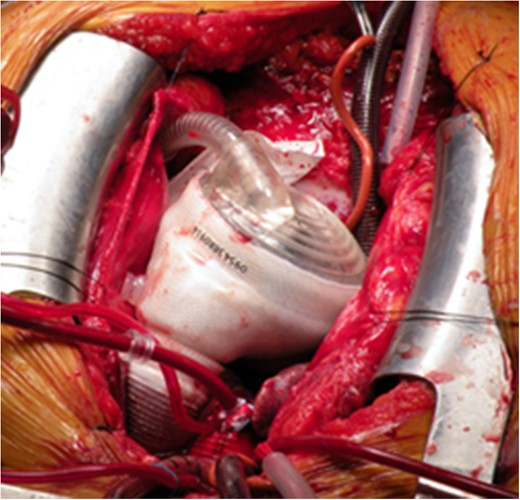 Implantation of TAH was completed.