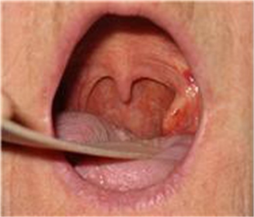 Appearance at initial presentation with intraoral projection of styloid process.