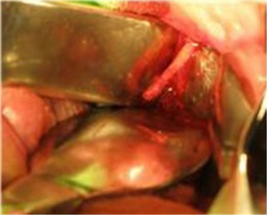 Intraoperative view of the styloid process with the soft tissues reflected.