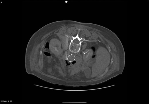 CT scan showing an abscess formation around the aortic stentgraft and a needle in the abscess for drainage. Note the presence of air bubbles in the abscess.