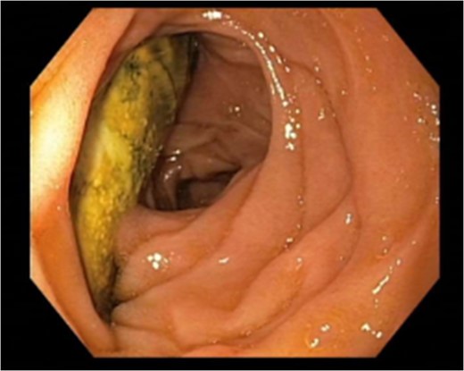 Endoscopy performed November 2016 revealing breakthrough of aortic graft material into the last part of the duodenum.
