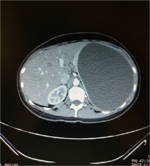 Axial CT scan abdomen showing cyst.