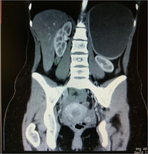 Coronal CT with cyst compressing left kidney.