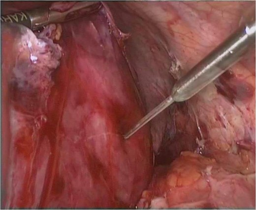 Aspiration of cyst fluid carried out.