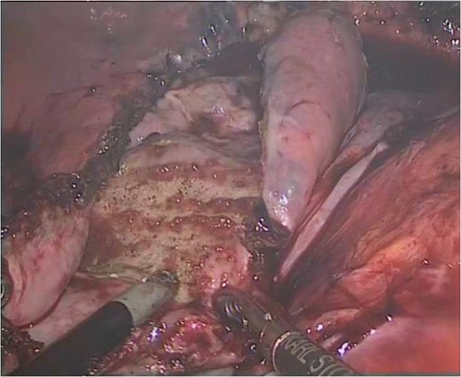 Cauterization of inner wall of cyst attached to spleen.