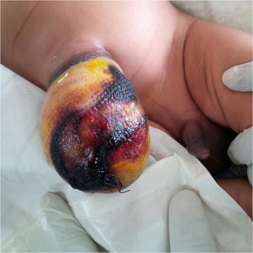 Photograph of the index patient after 7 days of conservative management of omphalocele major using honey dressing.