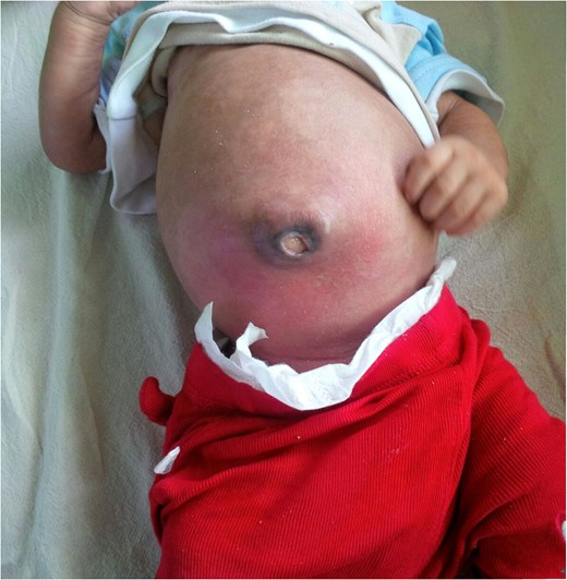 Photograph of the same patient depicting complete fascial closure after 6 weeks of conservative management with honey dressing.