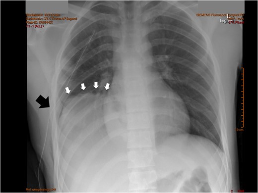 Initial chest X-ray after placement of thoracic drain. White arrows note a high-stand of the right diaphragm, black arrow points to chest drain.