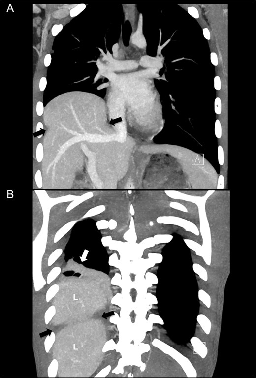 Computed tomography of right-sided diaphragm rupture and herniated liver. (A) CT performed after transfer showing ruptured diaphragm (black arrows) with herniated liver into the right thoracic cavity. (B) A more posterior view with pulmonary atelectasis (white arrow). L denotes liver.