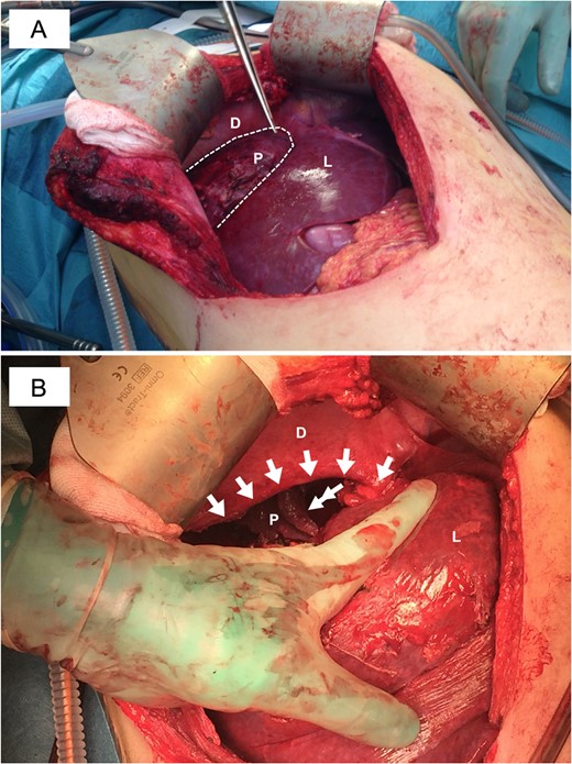 Intraoperative view of the diaphragmatic injury. (A) View showing the diaphragm (D) with the defect illustrated by dotted line and the pulmonary (P) tissue adhered to the liver (L) surface. (B) After dissection of adhesions and release of the lung (P) the defect was measured to ~10 cm in the mediolateral extension (extending almost at the insertion of the right hepatic vein to the lateral part of the diaphragmatic dome) and ~5 cm in the anterioposterior direction.