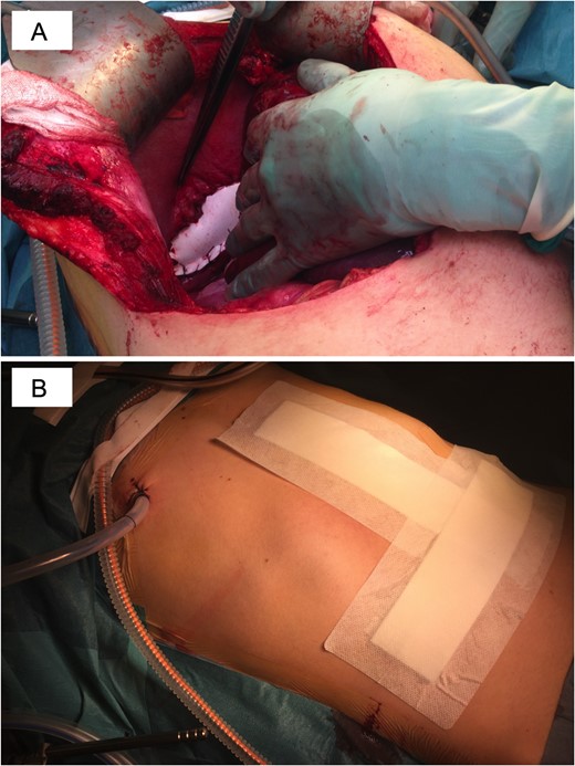 Surgical repair of diaphragmatic defect using a Gore-tex mesh. (A) A polytetrafluoroethylene mesh (Gore-Tex™) was sutured to cover the defect. (B) A chest drain was placed and kept for 3 days.