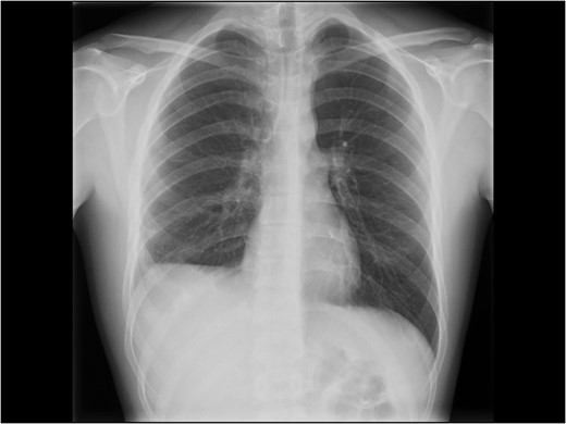 Chest X-ray at follow-up. Still some degree of diaphragm high-stand on the right side.