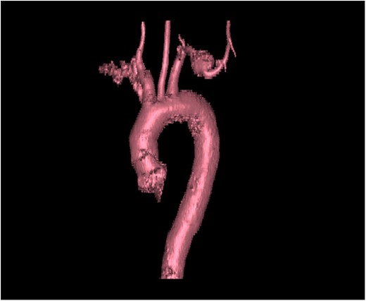 3D CT reconstruction of the big vessels. Note aneurysm location at the midportion of the subclavian artery.